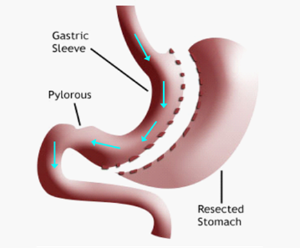 Surgical Weight Loss