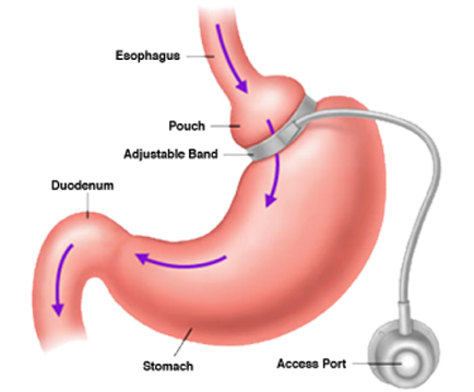 Surgical Weight Loss