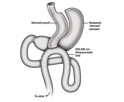 Surgical Weight Loss