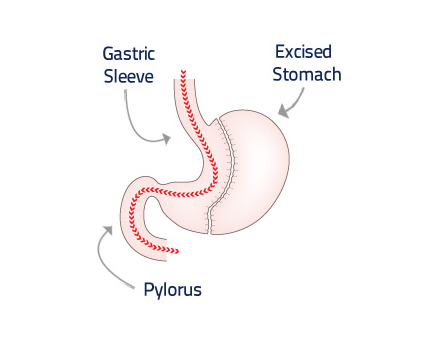 Surgical Weight Loss