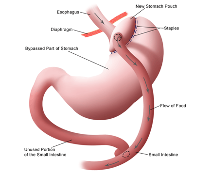 Surgical Weight Loss